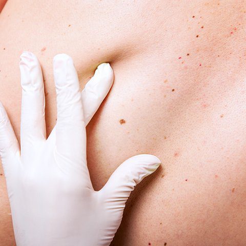 A person being screened for skin cancer.