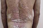 before Psoriasis - Skin Care Clinic - Birmingham Dermatology Clinic and Medical Spa | Cahaba Dermatology