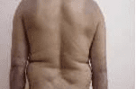 After Psoriasis - Skin Care Clinic - Birmingham Dermatology Clinic and Medical Spa | Cahaba Dermatology