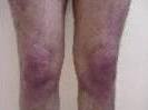 UVB Photo after - Birmingham Cosmetic Dermatologist - Medical Spa | Cahaba Dermatology