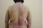 UVB Photo before - Birmingham Cosmetic Dermatologist - Medical Spa | Cahaba Dermatology