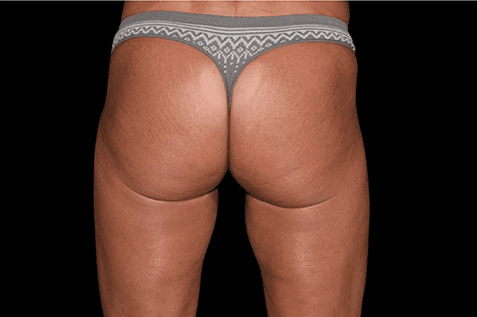 female abdomen - coolsculpting - Birmingham Dermatology Clinic & Medical Spa | Cahaba Dermatology