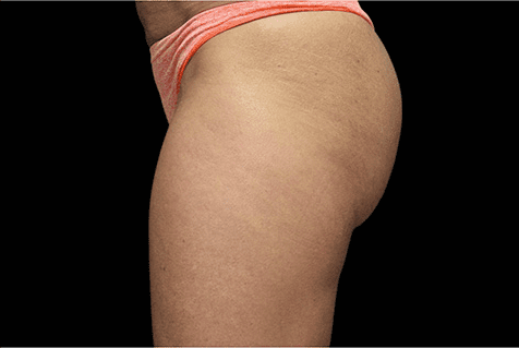 emsculpt - non invasive cosmetic surgery - Birmingham Dermatology Clinic & Medical Spa | Cahaba Dermatology