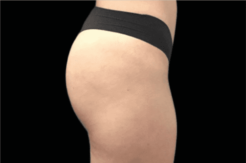 before non invasive cosmetic surgery - Skin Care Clinic - Birmingham Dermatology Clinic and Medical Spa | Cahaba Dermatology