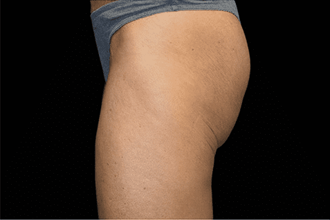 before coolsculpting - Skin Care Clinic - Birmingham Dermatology Clinic and Medical Spa | Cahaba Dermatology