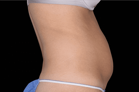 before emsculpt - Skin Care Clinic - Birmingham Dermatology Clinic and Medical Spa | Cahaba Dermatology