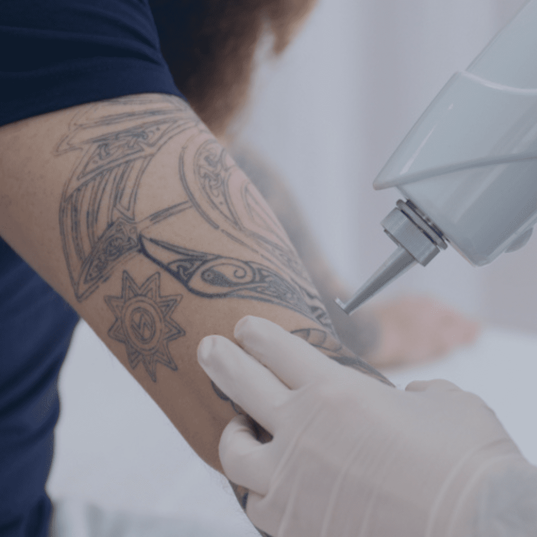 Man getting tattoo removal | Dermatology clinic Birmingham