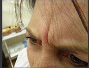 before botox - Birmingham Cosmetic Dermatologist - Medical Spa | Cahaba Dermatology