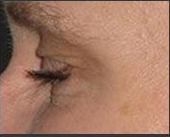botox after - Birmingham Cosmetic Dermatologist - Medical Spa | Cahaba Dermatology