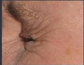 botox before - Birmingham Cosmetic Dermatologist - Medical Spa | Cahaba Dermatology