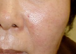 spot treatment - Birmingham Cosmetic Dermatologist - Medical Spa | Cahaba Dermatology