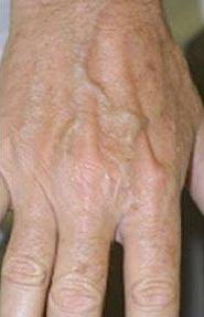brown spot treatment - Birmingham Cosmetic Dermatologist - Medical Spa | Cahaba Dermatology