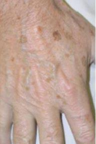 brown spot - Birmingham Cosmetic Dermatologist - Medical Spa | Cahaba Dermatology