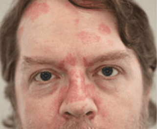 laser treatment before - Birmingham Cosmetic Dermatologist - Medical Spa | Cahaba Dermatology
