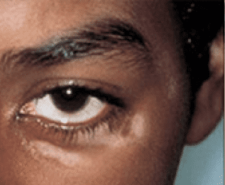 laser skin treatment before - Birmingham Cosmetic Dermatologist - Medical Spa | Cahaba Dermatology