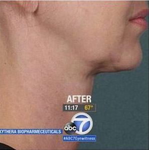 kybella after - Birmingham Cosmetic Dermatologist - Medical Spa | Cahaba Dermatology