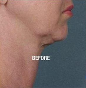 kybella before - Birmingham Cosmetic Dermatologist - Medical Spa | Cahaba Dermatology