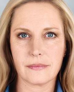 sculptra after - Birmingham Cosmetic Dermatologist - Medical Spa | Cahaba Dermatology