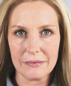 sculptra before - Birmingham Cosmetic Dermatologist - Medical Spa | Cahaba Dermatology