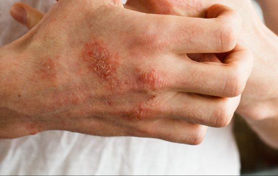 eczema - Skin Care Clinic - Birmingham Dermatology Clinic and Medical Spa | Cahaba Dermatology